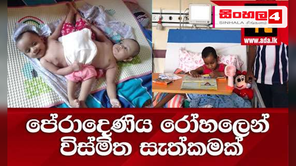 ලොව ප්‍රථම වතාවට පේරාදෙණිය රෝහලෙන් වෛද්‍ය විස්කමක්: බද්ධ වී සිටි නිවුන් දරුවන් වෙන් කෙරේ