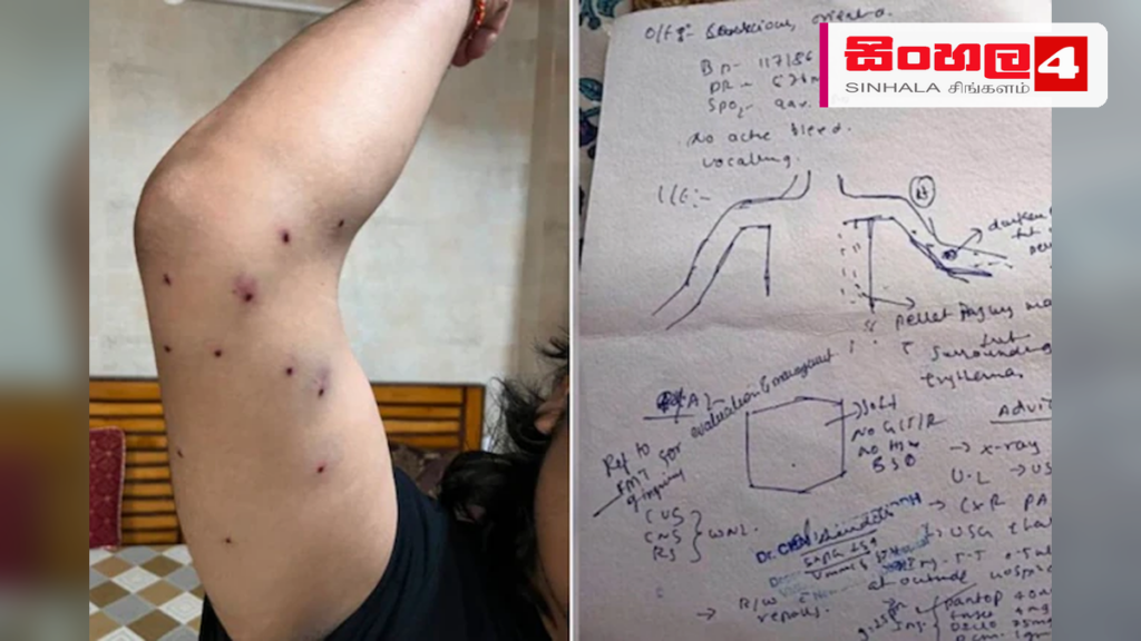 ඉන්දීය විරෝධතාවකදී පෙලට් තුවක්කු භාවිත කළ බවට රෝහල් වාර්තාවකින් හෙළිදරව් ඉන්දීය විරෝධතාවකදී පෙලට් තුවක්කු භාවිත කළ බවට රෝහල් වාර්තාවකින් හෙළිදරව්